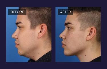 Kybella: Cost, Side Effects, and What to Expect .